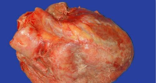 纤维蛋白性心包炎 纤维蛋白性心包炎最突出的症状是
