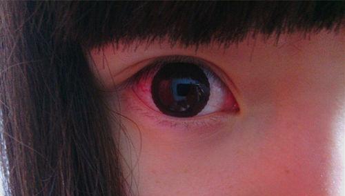 眼充血的偏方 缓解眼充血的方法