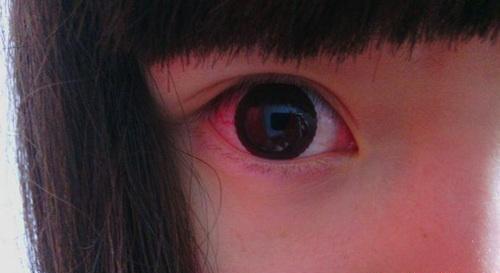 红眼的偏方 红眼病秘方