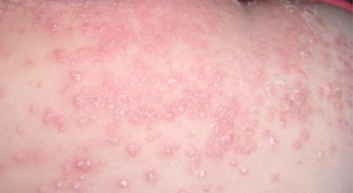 干燥型湿疹的偏方