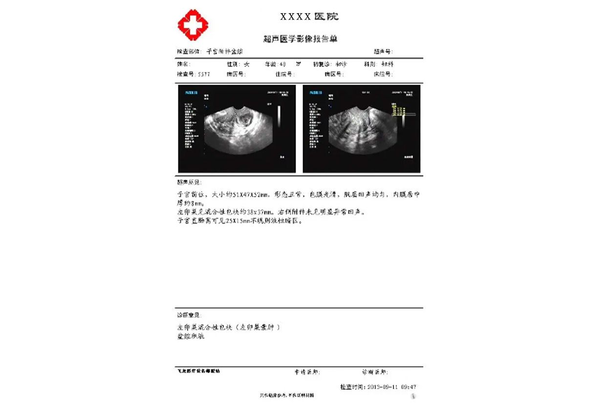 卵巢囊肿诊断证明图片 卵巢囊肿诊断书图片