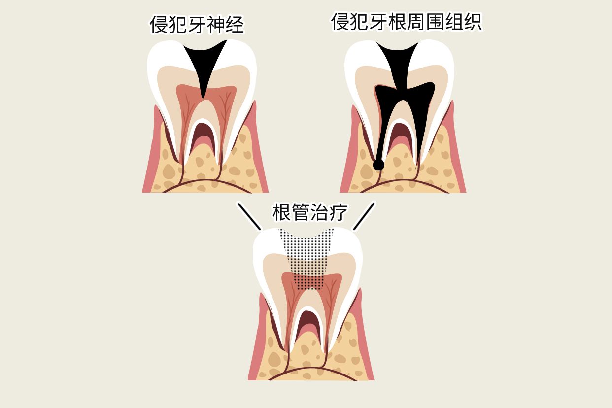 牙烂到什么程度要根管治疗图片