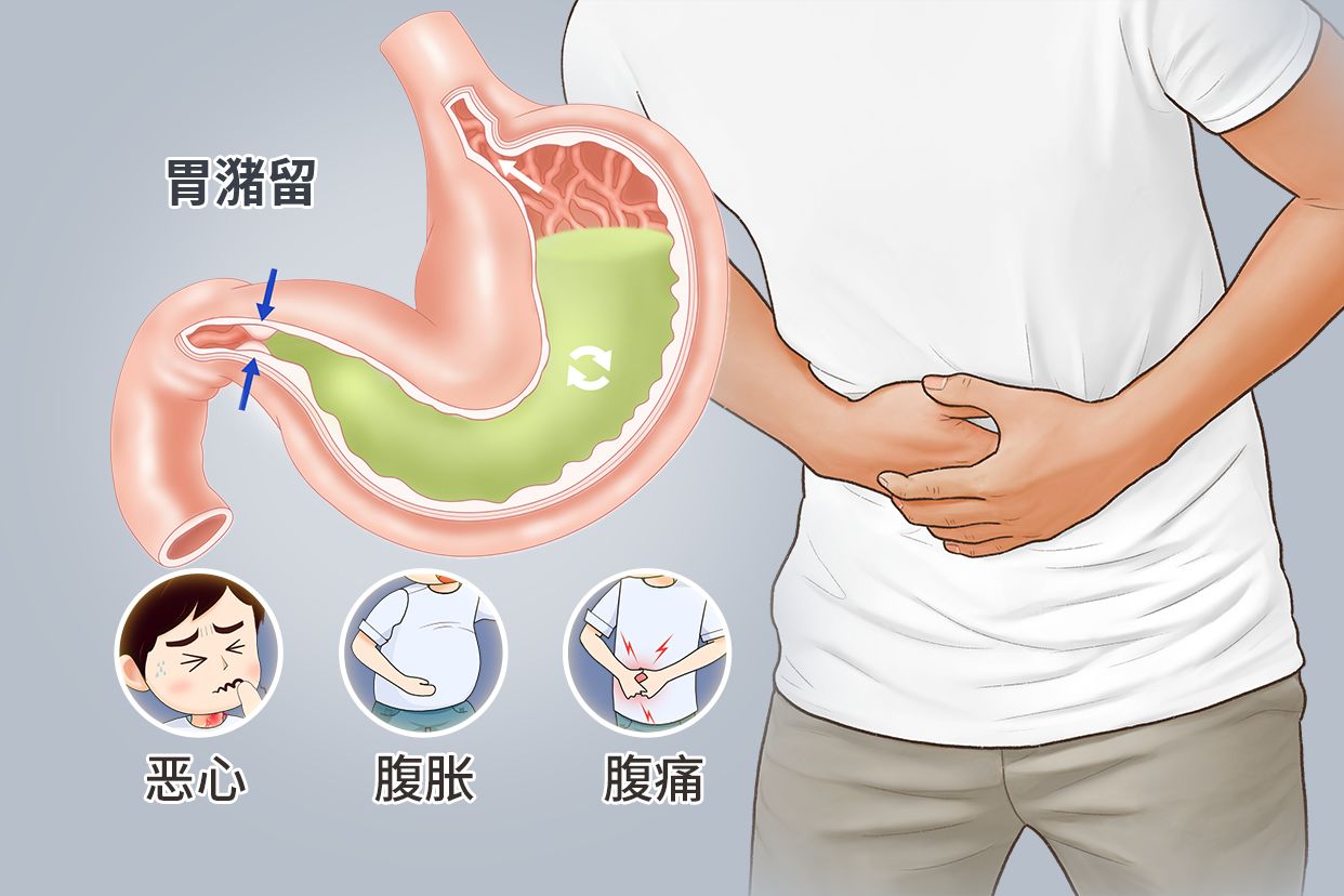 胃潴留图片（胃潴留胃镜图片）