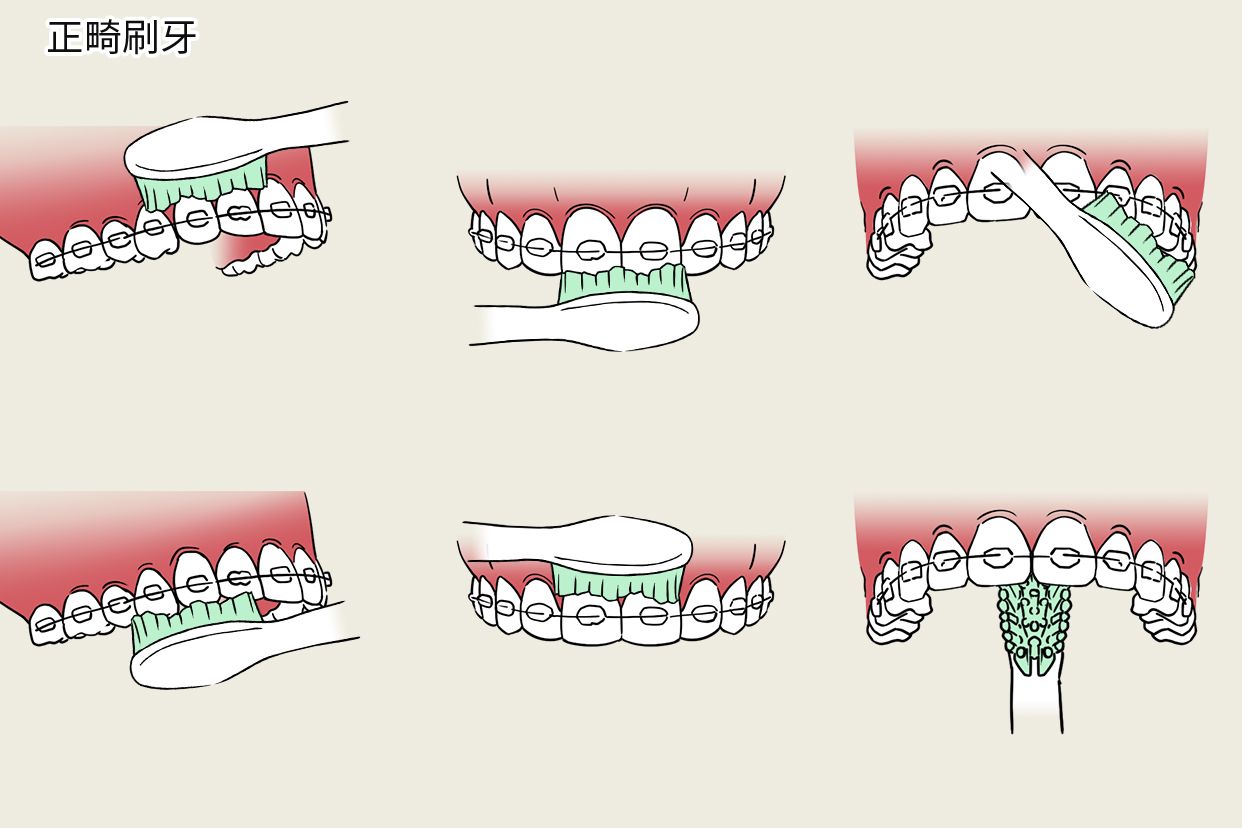 正畸刷牙步骤图片（正畸牙怎么刷）