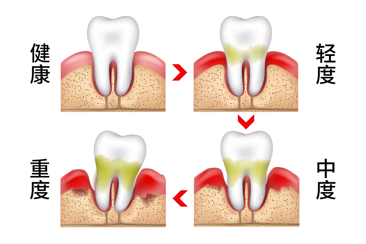 牙周轻中重度前后图片 重中度牙周炎矫正前后