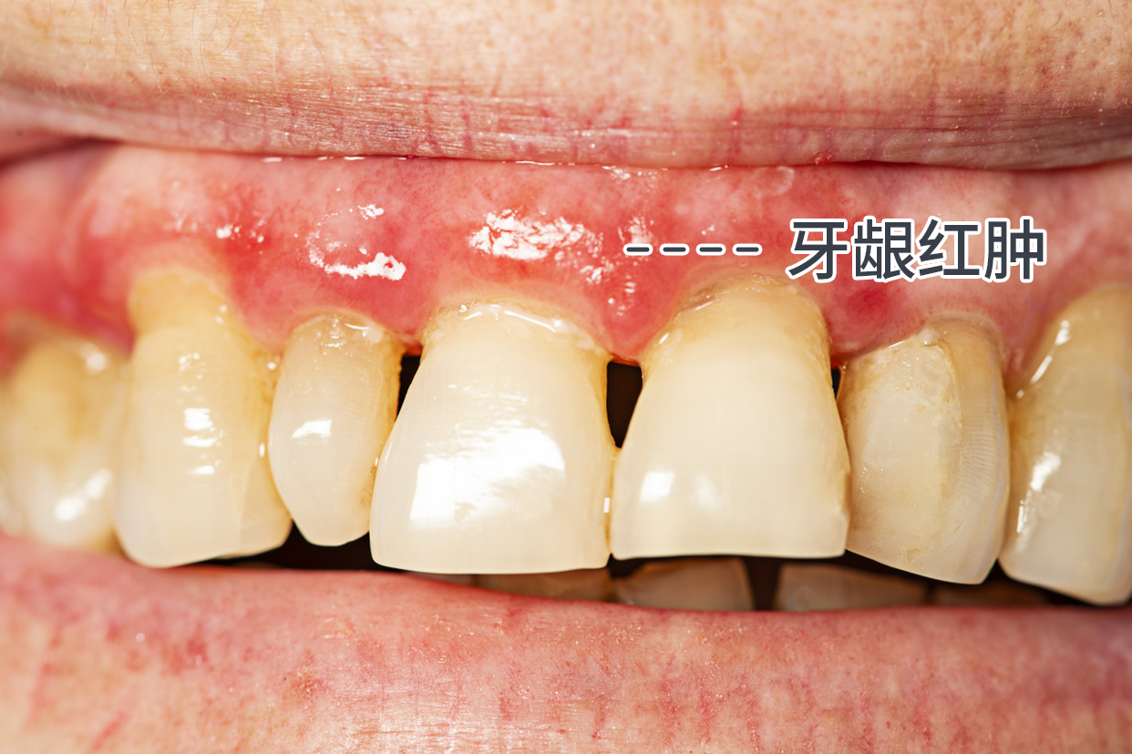 牙周炎牙龈红肿的图片 牙龈发炎肿痛的图片