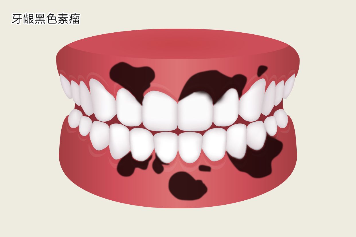 牙龈黑色素瘤图片（牙龈黑色素瘤早期图片）