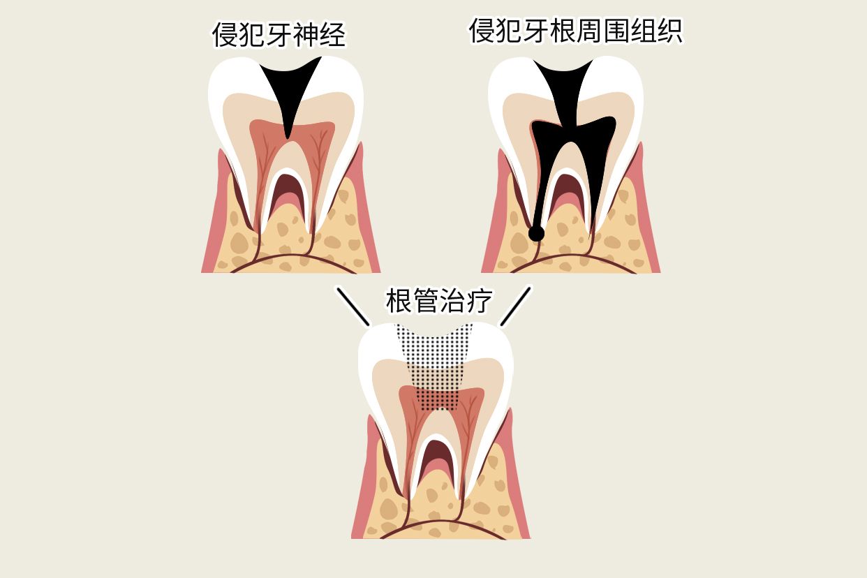牙烂到什么程度要根管治疗图片 牙烂到什么程度还能治