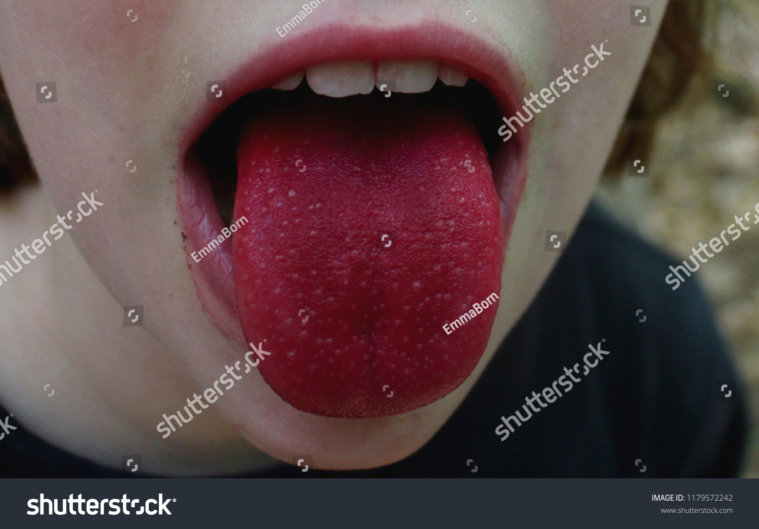 舌红是什么症状图片（舌红是什么样子）