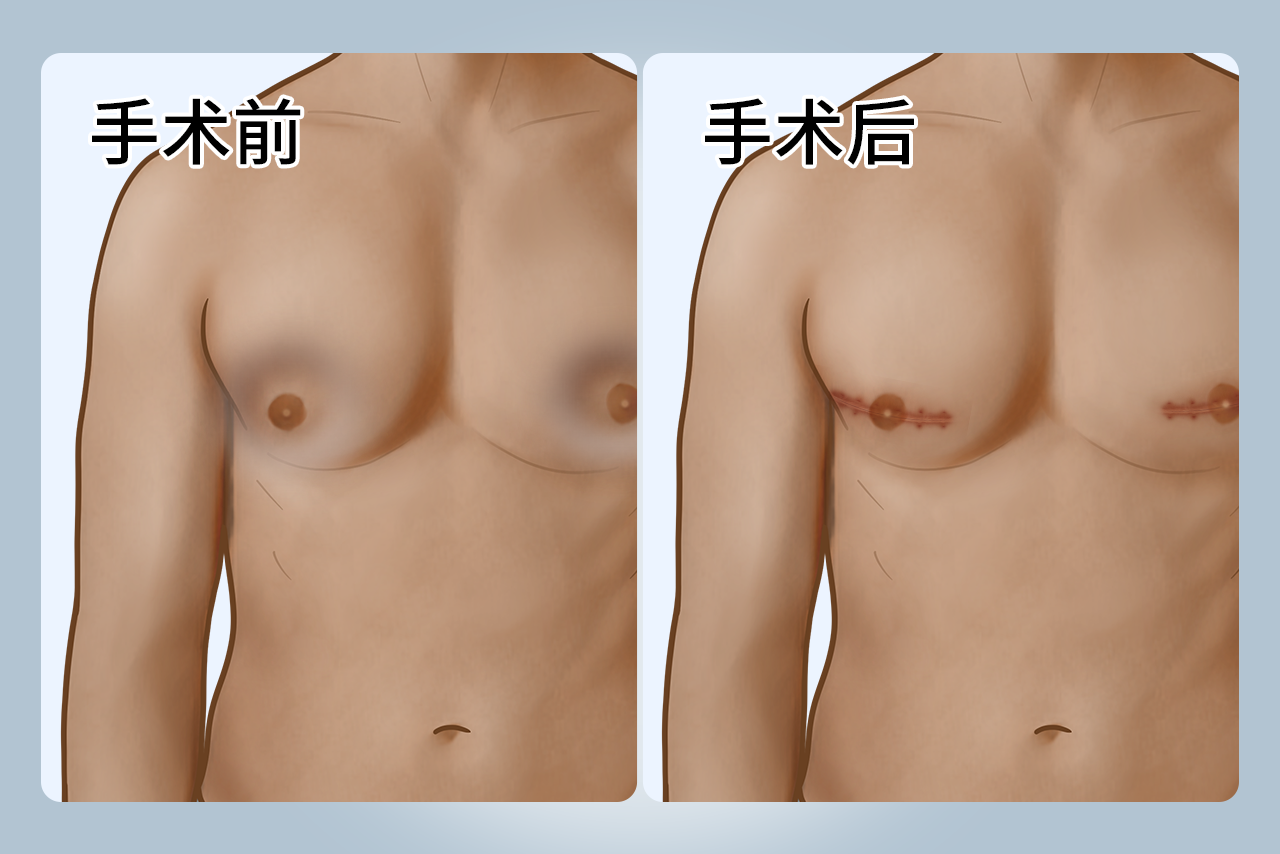 男性乳房手术后凹陷填充图片 男性乳房发育手术后凹陷