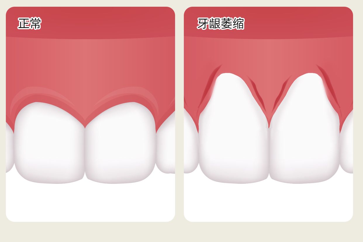 正常没萎缩的牙龈图片 正常没萎缩的牙龈图片