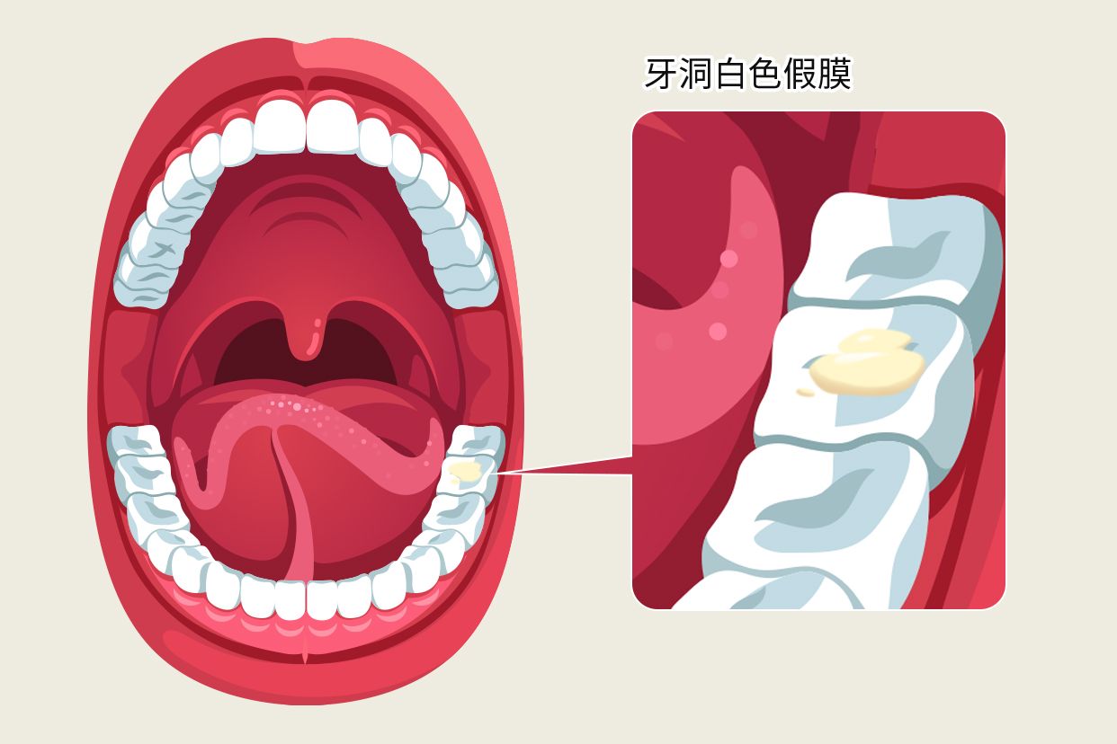 牙洞白色假膜图片 牙洞白色假膜图片高清