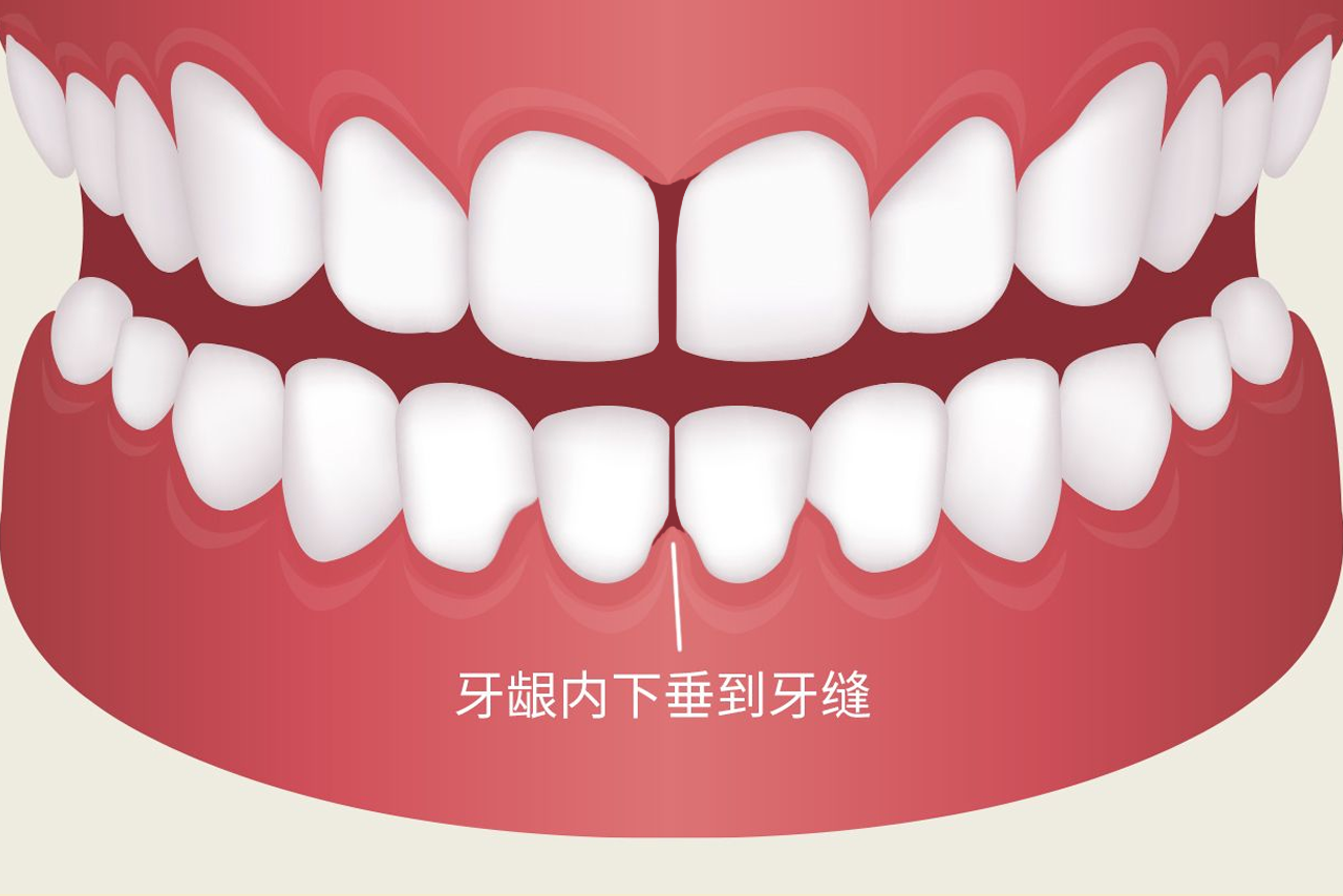 牙龈内下垂到牙缝是什么引起的图片（牙龈下垂怎么办）
