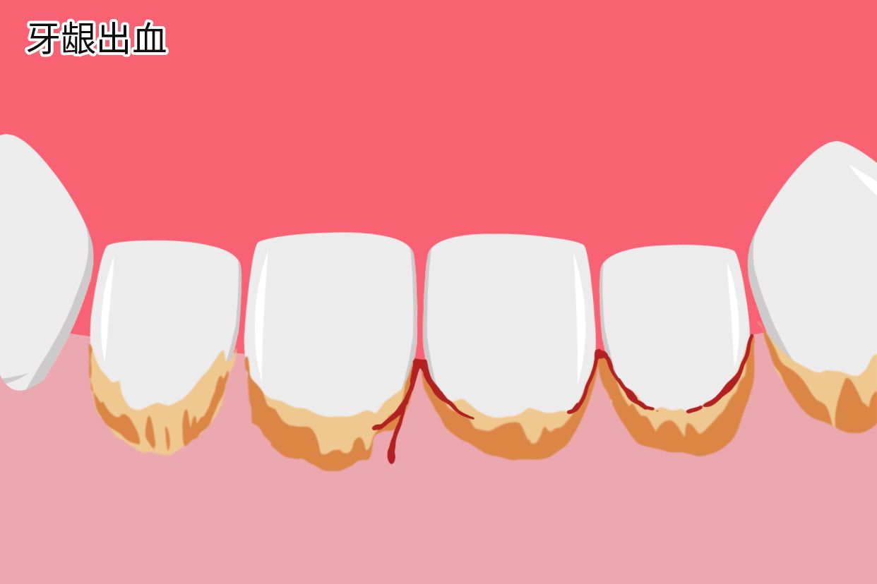 牙结石会导致牙龈出血吗图片 牙结石会导致牙龈出血吗图片大全