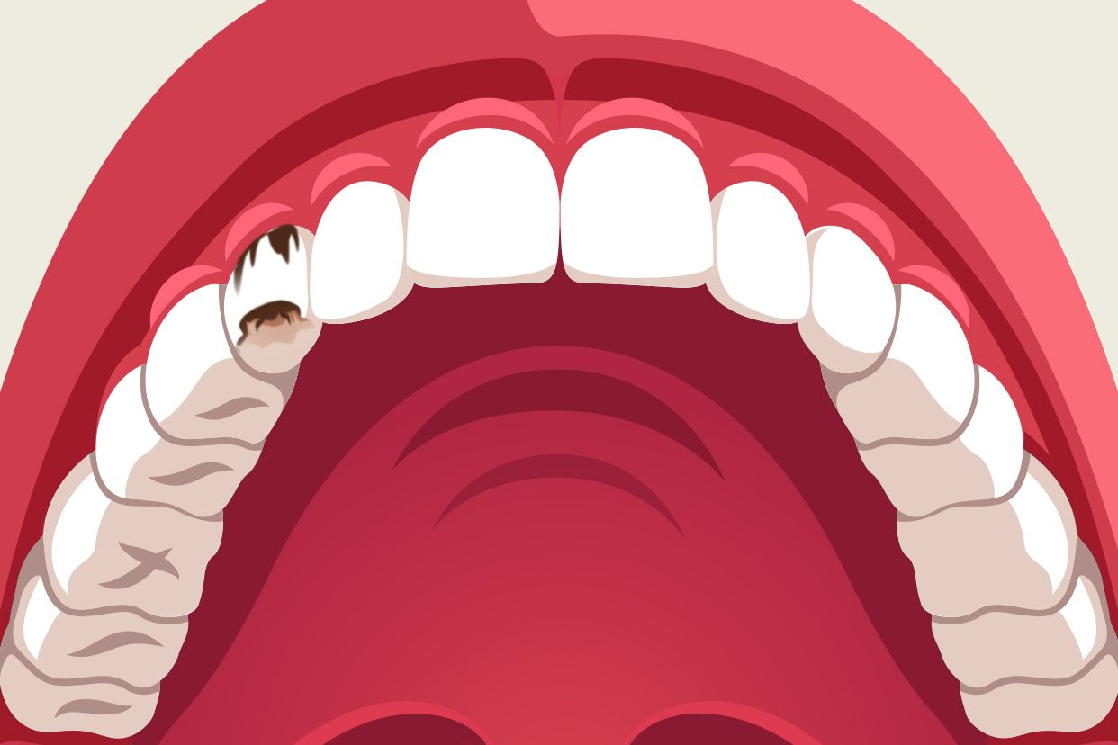 尖牙蛀牙图片（尖牙龋齿图片）
