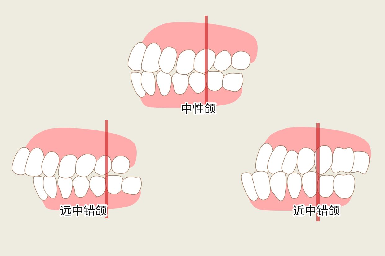 angle错颌分类图解 angle错颌畸形的分类图片