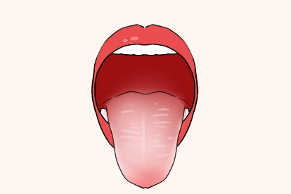 舌红苔白图片（舌苔红和舌苔白图片）