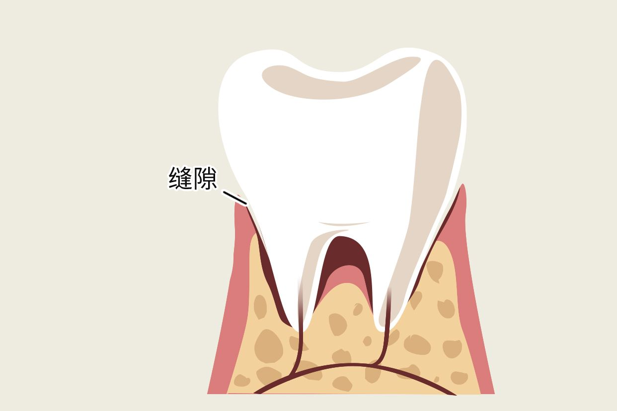 牙冠和牙龈有缝隙图（牙冠和牙龈有缝隙图片大全）