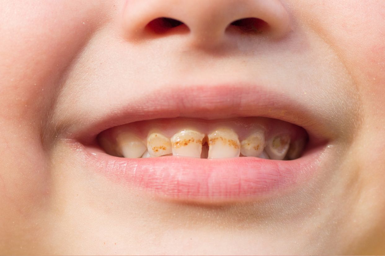 门牙龋齿严重程度分型图片（成人龋齿严重程度分型图片）