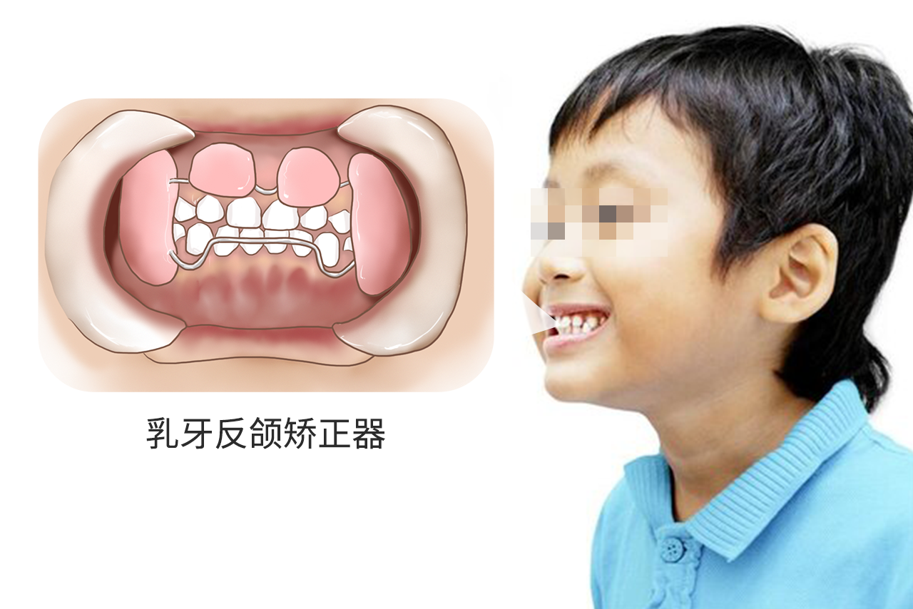 乳牙反颌矫正器图片 乳牙反颌矫正器图片