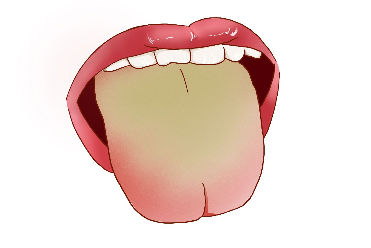 膀胱湿热舌苔图片（膀胱湿热的症状舌苔）