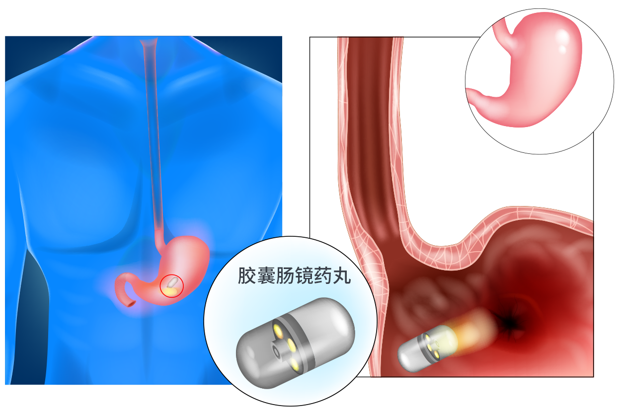 胶囊肠镜药丸图片（肠镜 药丸）