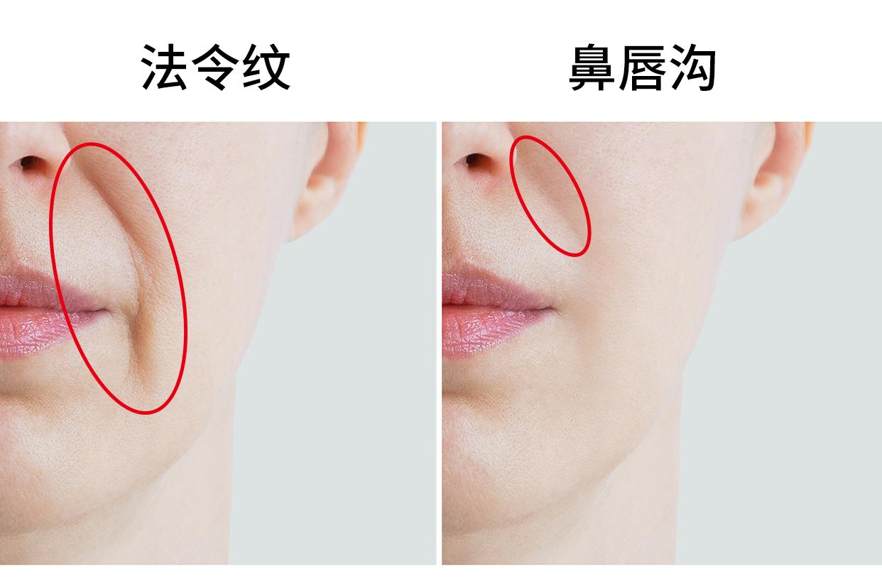 法令纹和鼻唇沟的区别图片 鼻唇沟皱纹是法令纹吗