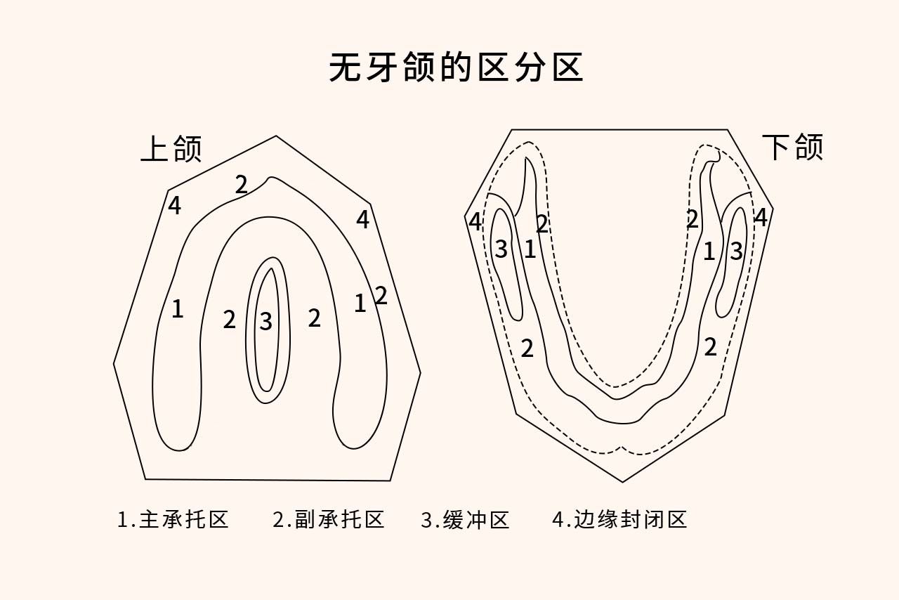 全口义齿无牙颌分区图（全口义齿无牙颌分区图片）