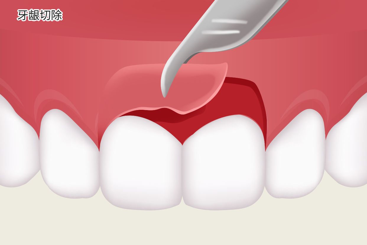 牙龈切掉能长吗图片 牙龈过长可以切吗