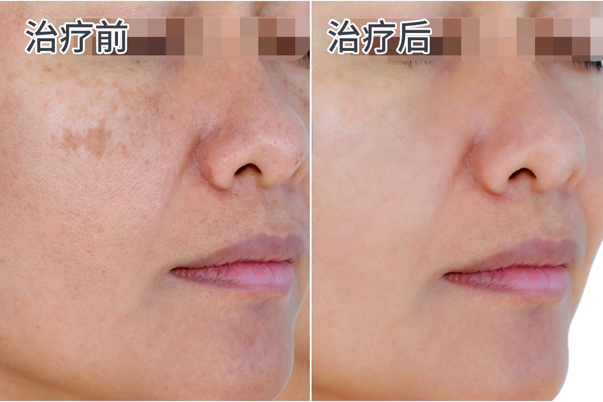 二氧化碳激光治疗老年斑后的图片（二氧化碳激光祛除老年斑）