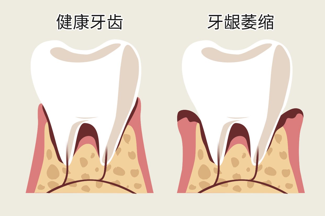 单个牙龈萎缩图片（正常牙龈和萎缩牙龈图片）