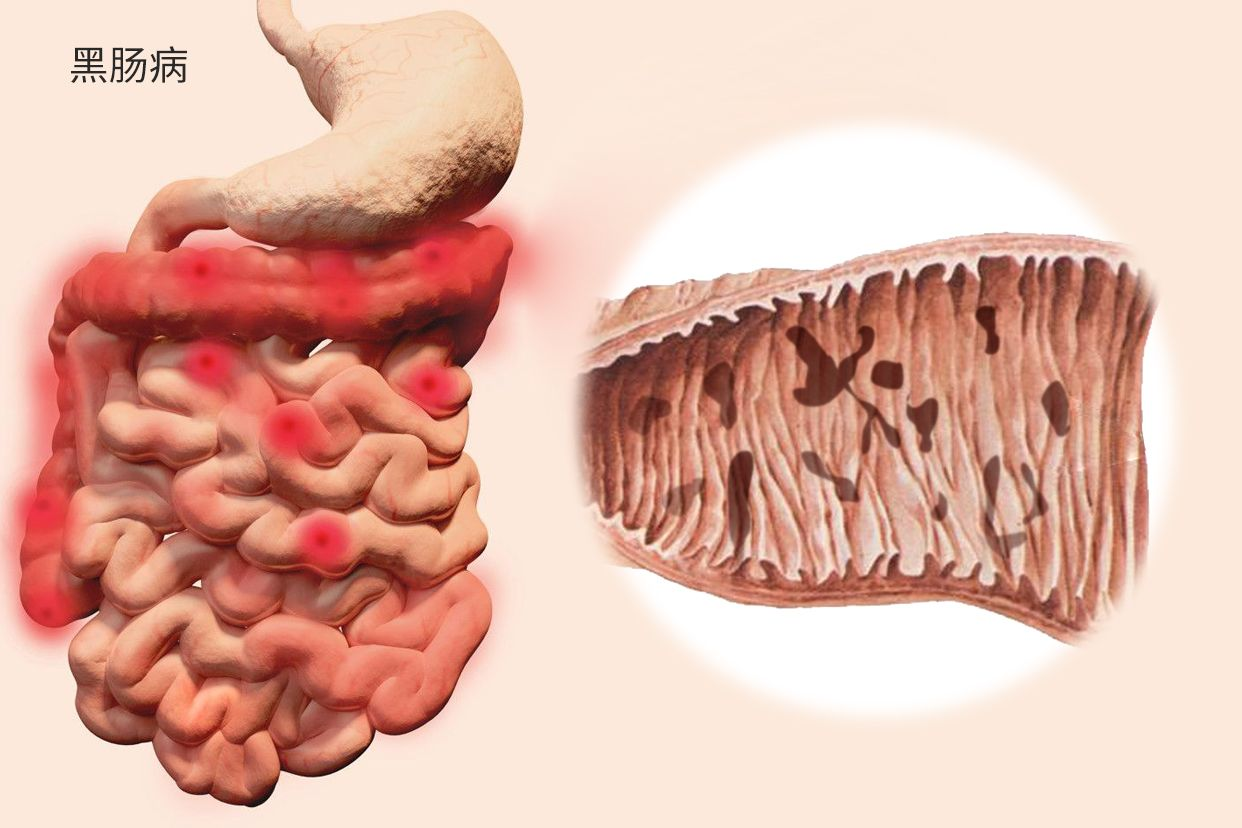 黑肠病图片（黑肠病）