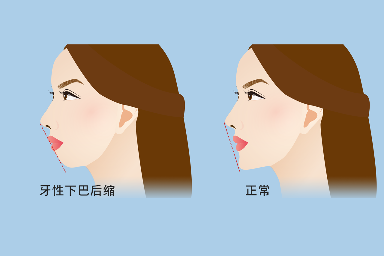 牙性下巴后缩图片（牙性下巴后缩怎么矫正）