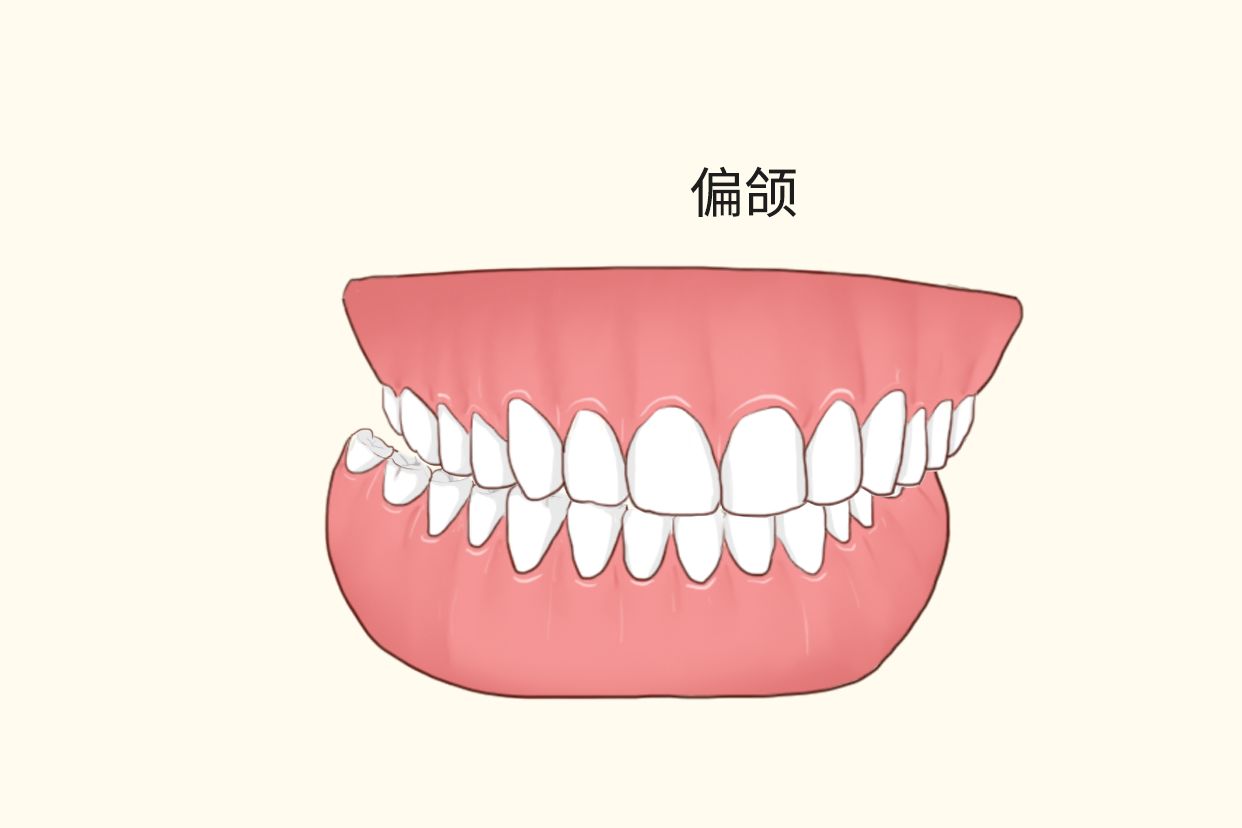 牙歪和偏颌关系图 牙歪和偏颌关系图示