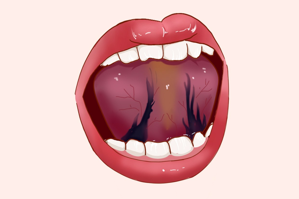 舌根淤堵图片 淤堵舌头图片