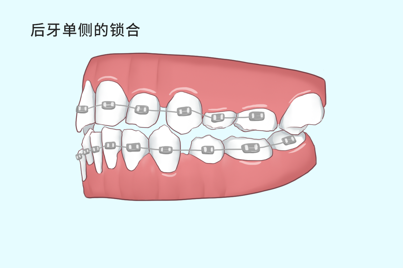 后牙单侧的锁合如何矫正图片 后牙单侧的锁合如何矫正图片