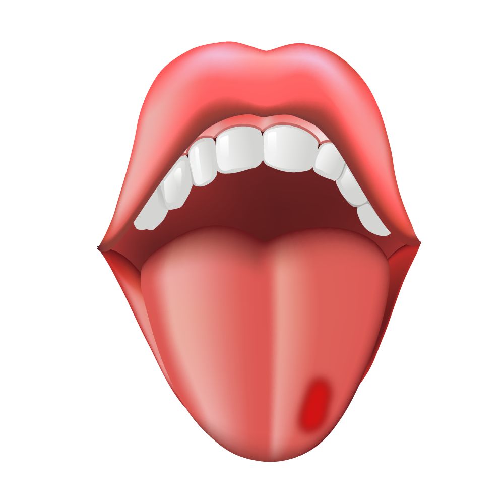 舌苔侧面有红斑图片 舌苔侧面有红斑图片女性