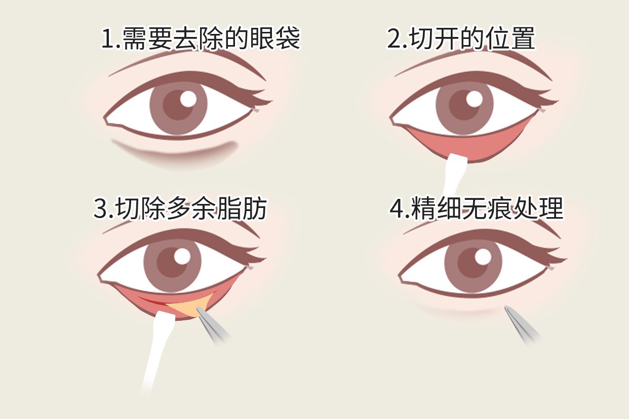 微创去眼袋过程图片 微创去眼袋手术过程