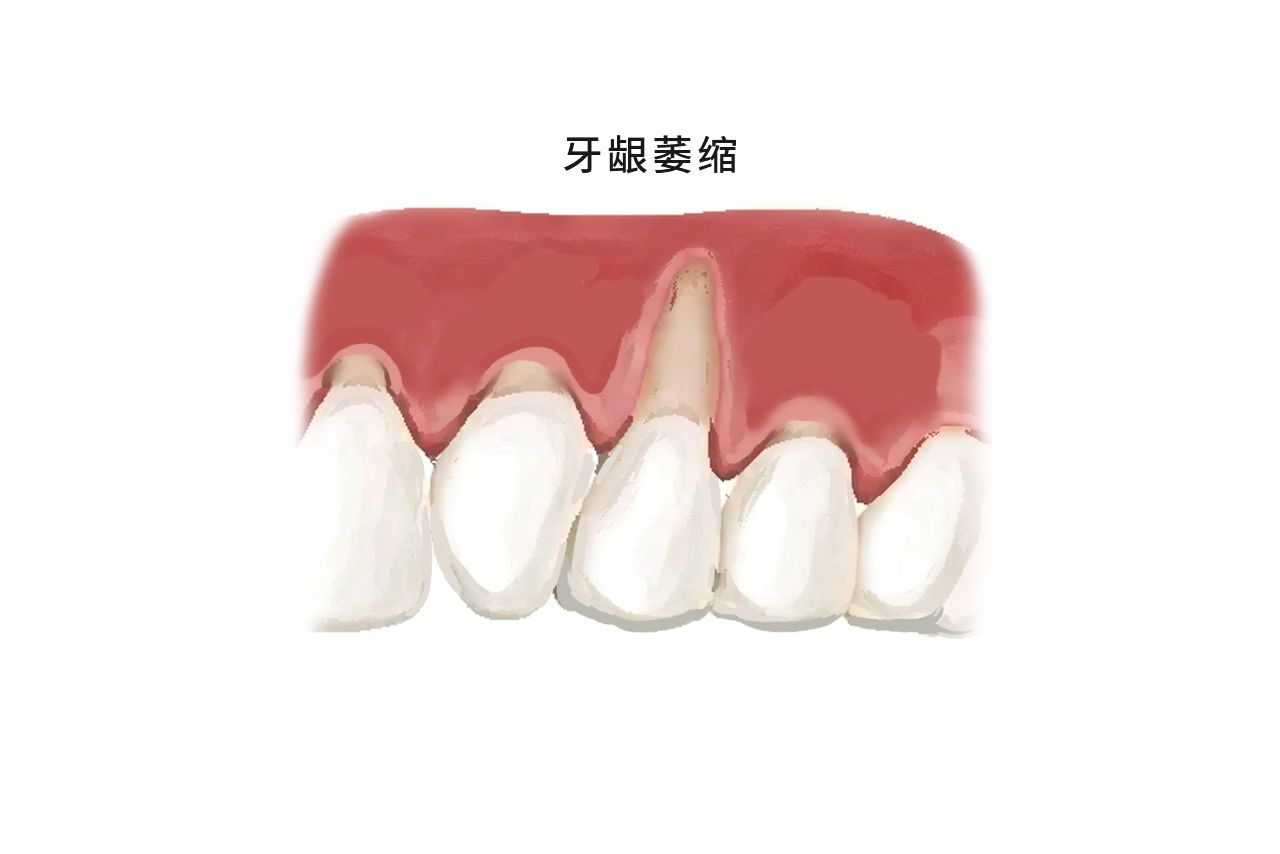 戴牙套牙龈萎缩图片 牙龈萎缩初期图片