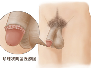 冠状沟皮脂腺异位图片 皮脂腺异位 冠状沟