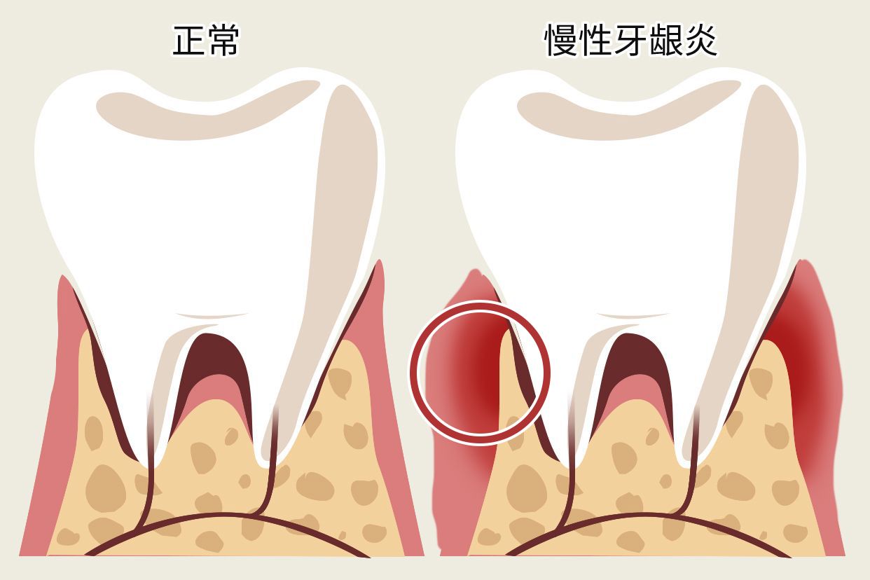 慢性牙龈炎图片（轻度牙龈炎症状图片）