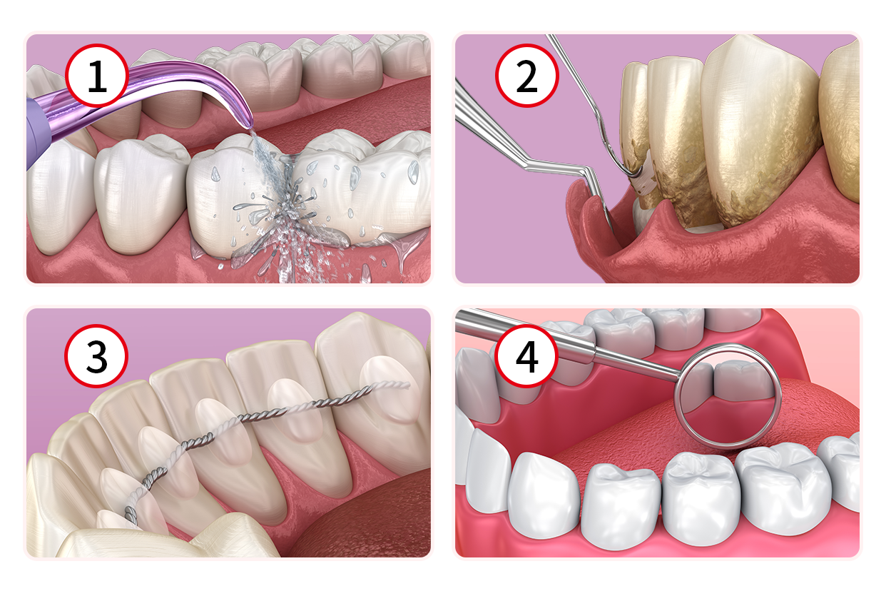牙周治疗四个步骤图解 牙周系统治疗流程图