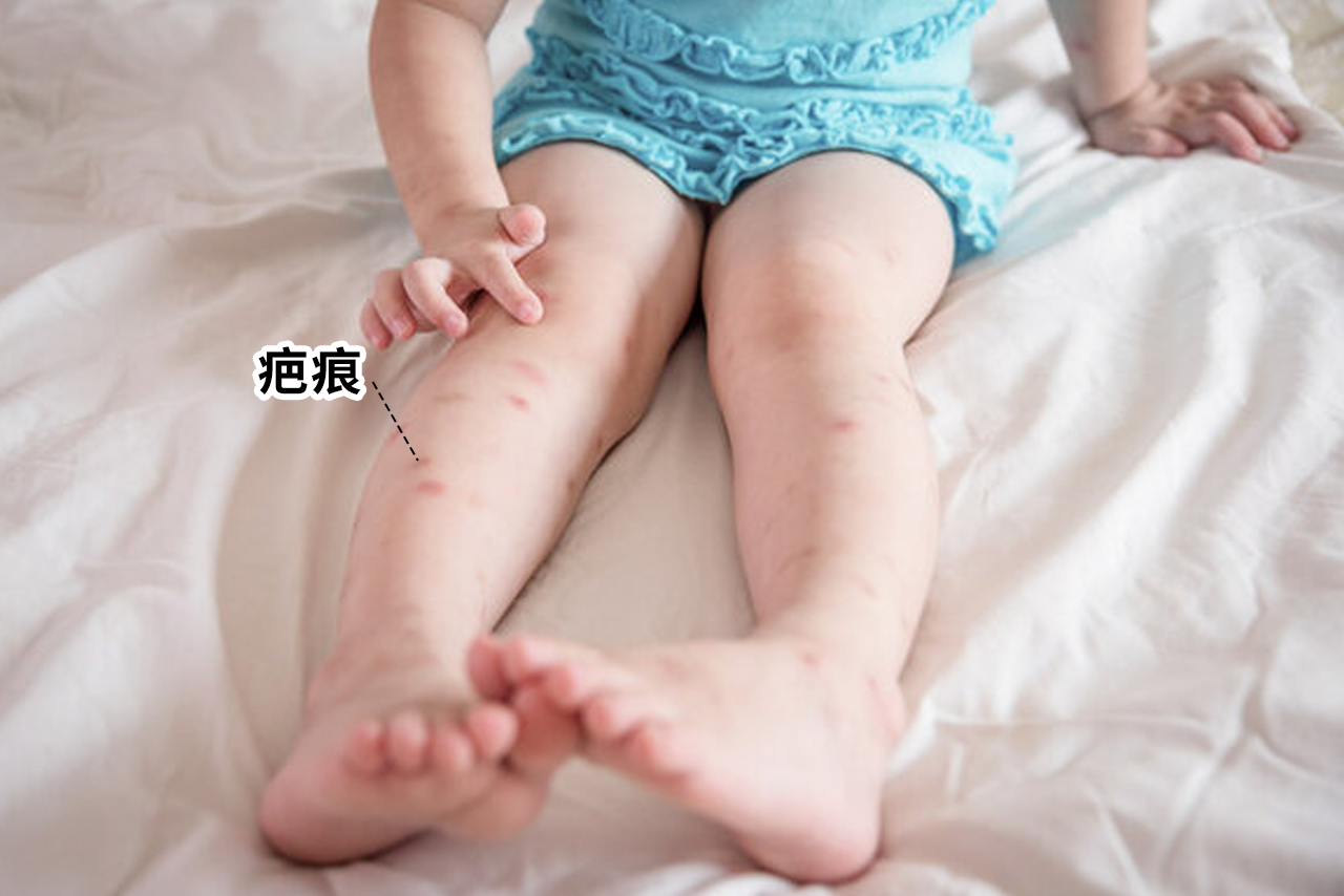 小孩疤痕图片（小宝宝有疤的图片）