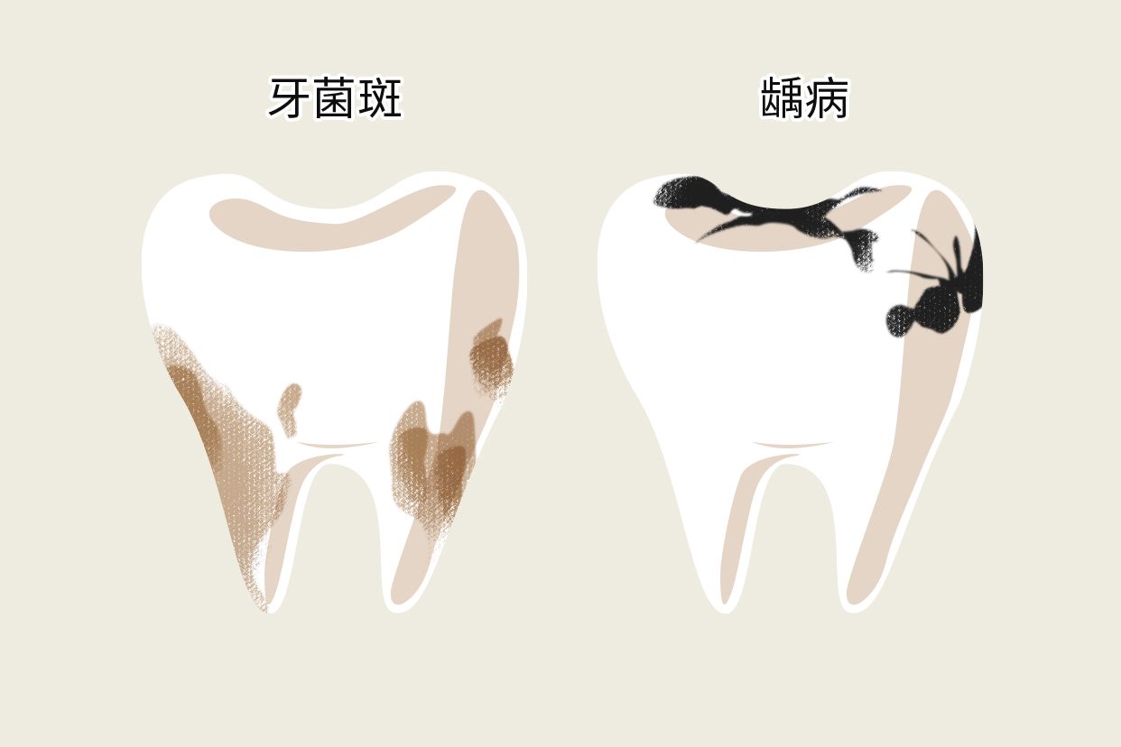 牙垢和蛀牙的区别图片 牙齿和牙垢的区别