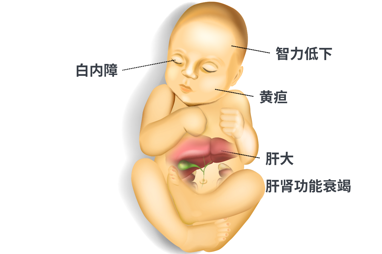 半乳糖血症患者图片