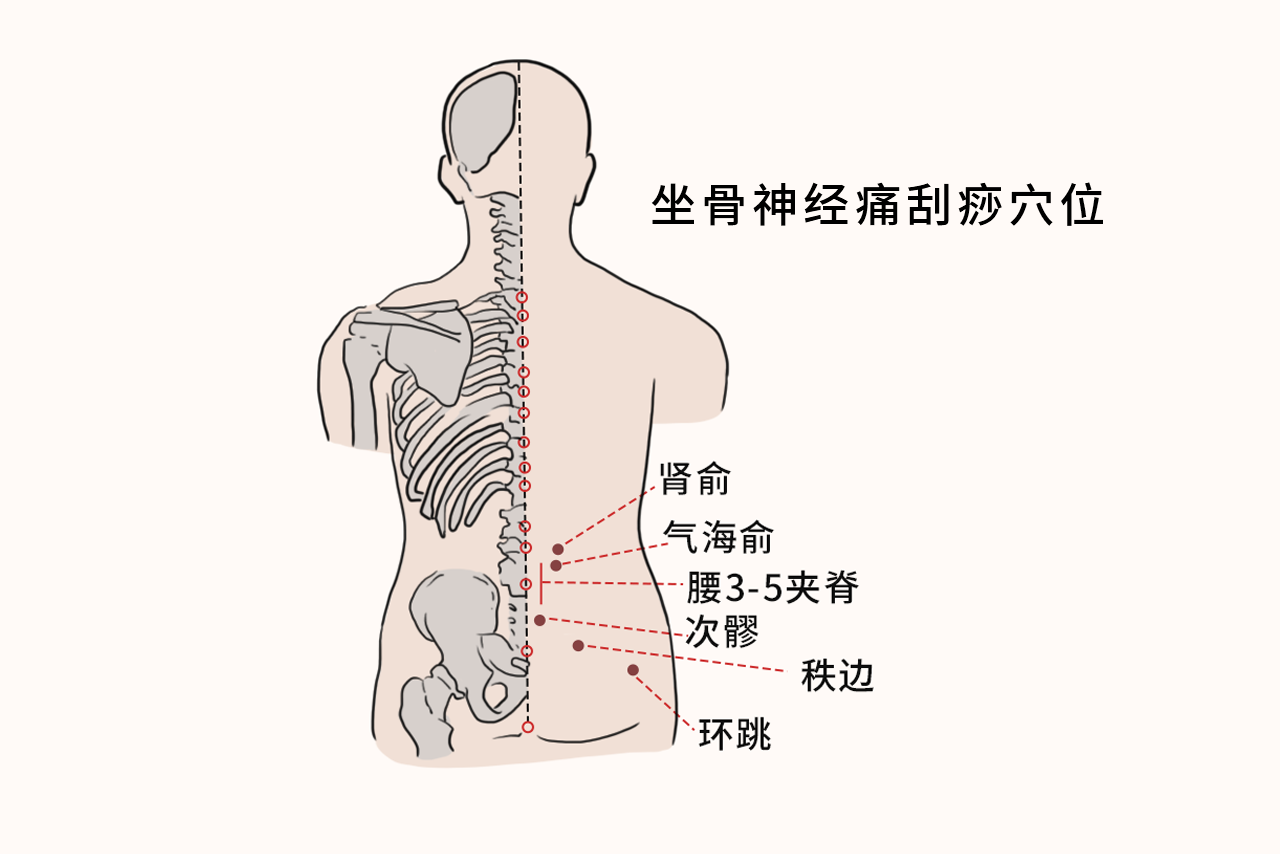 坐骨神经刮痧的方法示意图