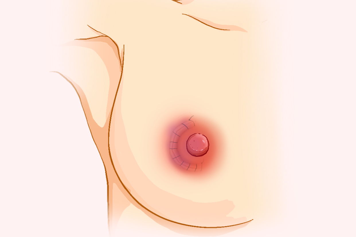 浆乳手术后的疤痕图片