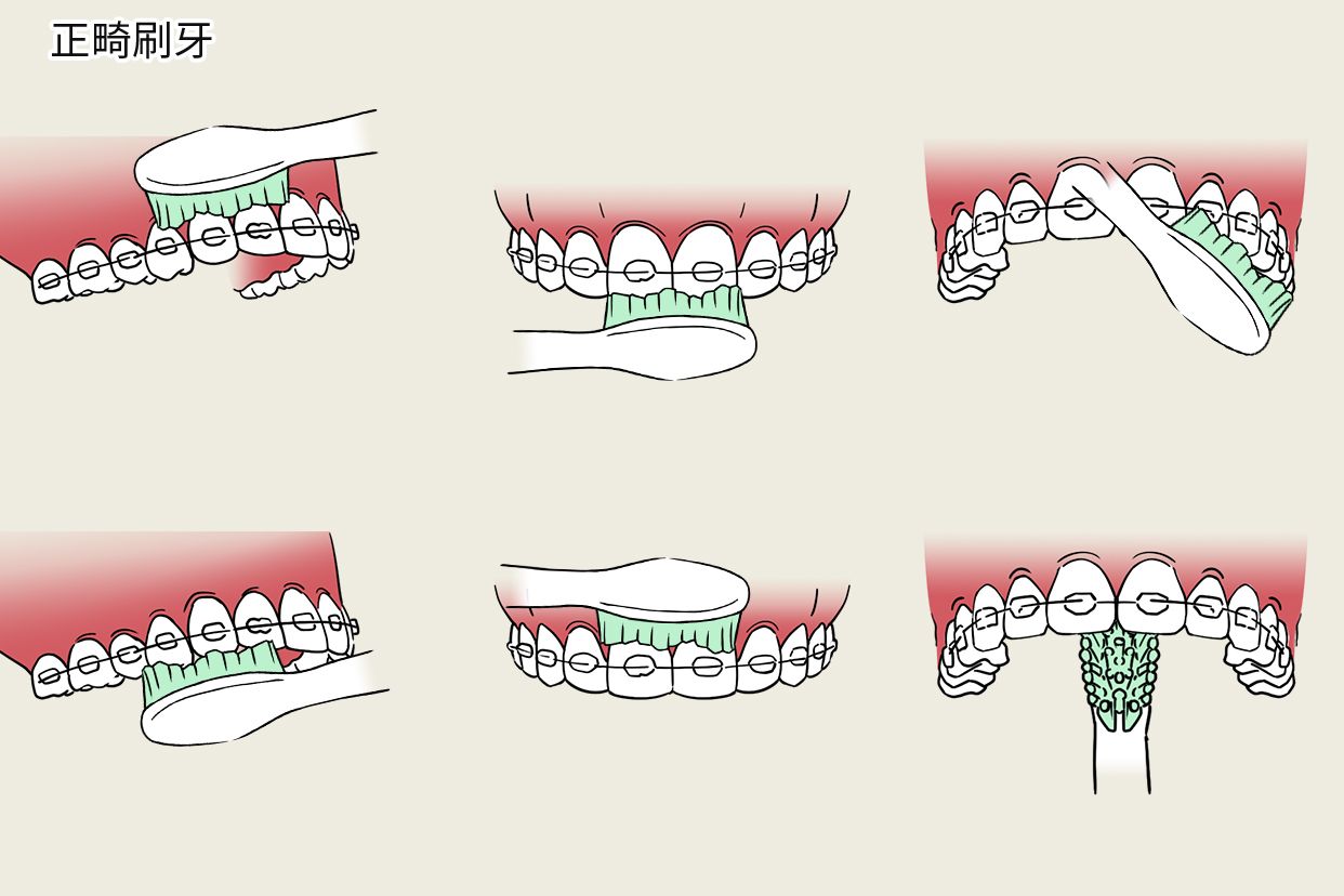 正畸刷牙步骤图片