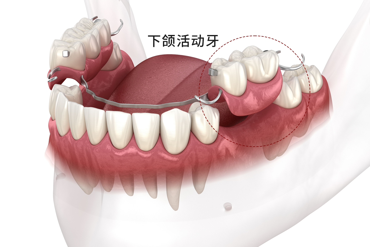 下颌活动牙图片