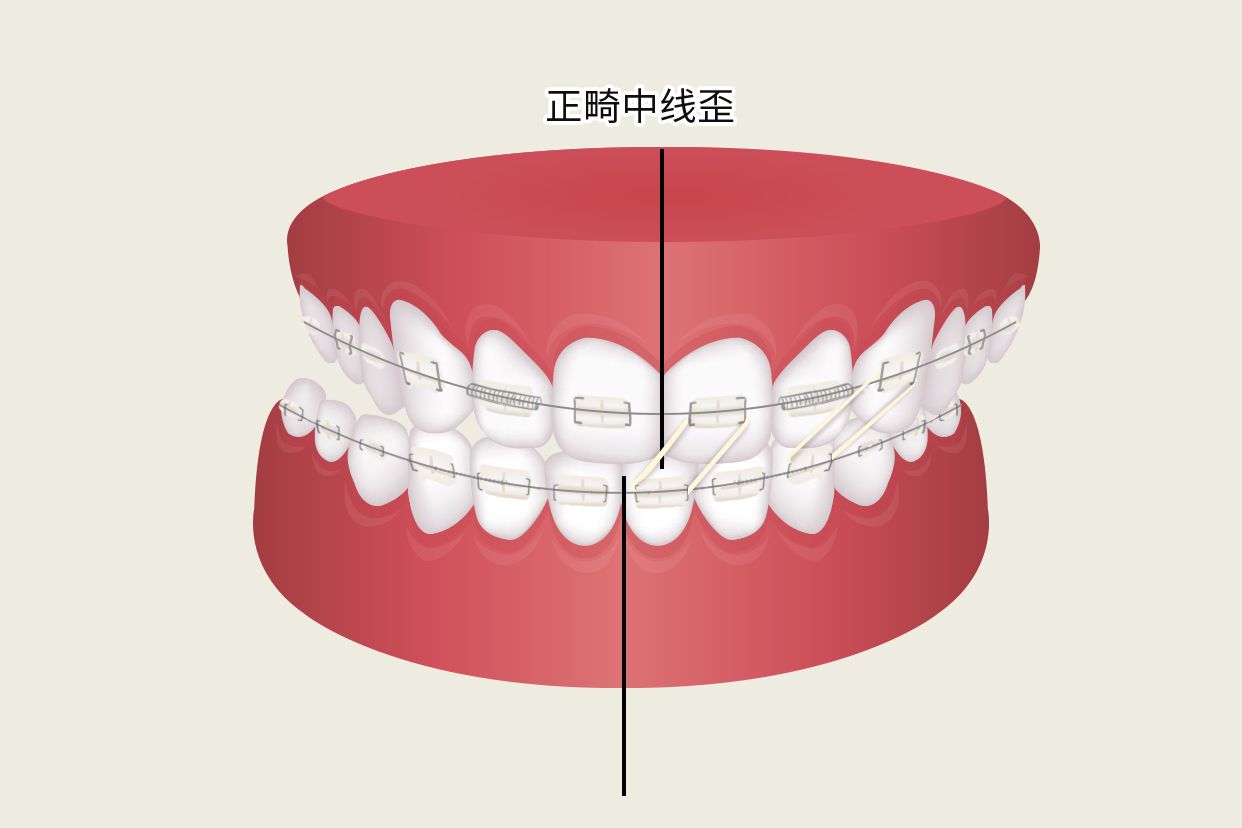 正畸中线歪如何牵引示意图